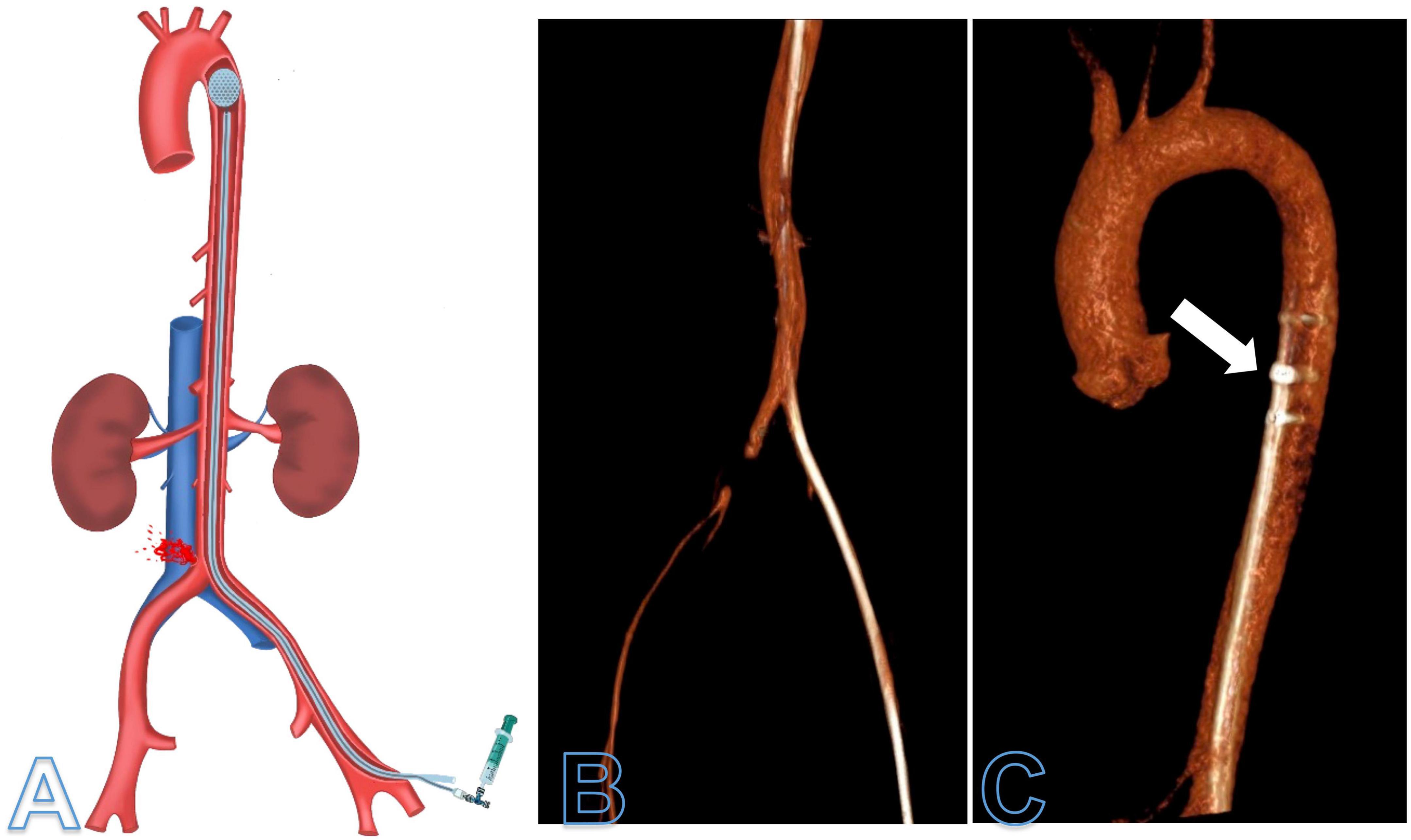 Case report: Resuscitative endovascular balloon occlusion after iatrogenic injury of the common iliac artery during neurosurgical dorsal lumbar microdiscectomy